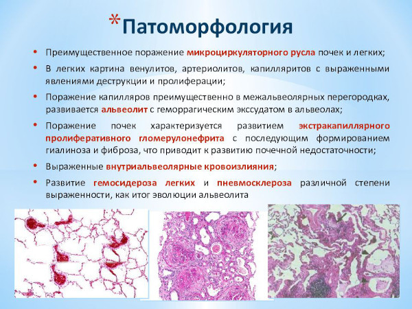 Синдром Гудпасчера это что такое. Диагностика, симптомы