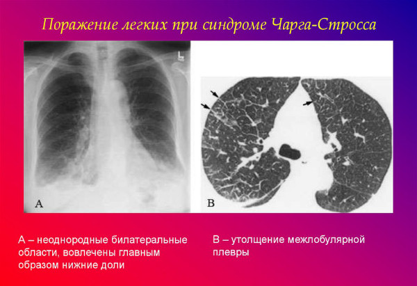 Синдром Гудпасчера это что такое. Диагностика, симптомы