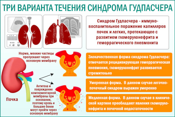 Синдром Гудпасчера это что такое. Диагностика, симптомы