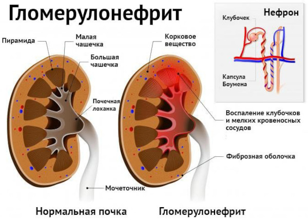 Синдром Гудпасчера это что такое. Диагностика, симптомы