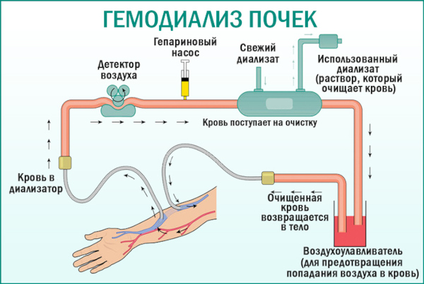 Синдром Гудпасчера это что такое. Диагностика, симптомы