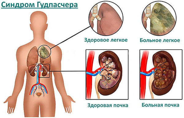 Синдром Гудпасчера это что такое. Диагностика, симптомы