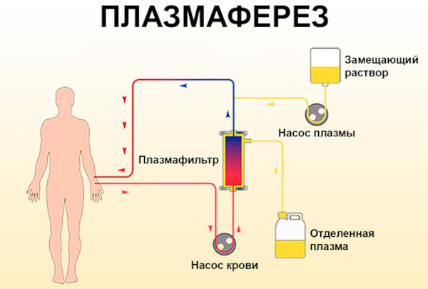 Синдром Гудпасчера это что такое. Диагностика, симптомы