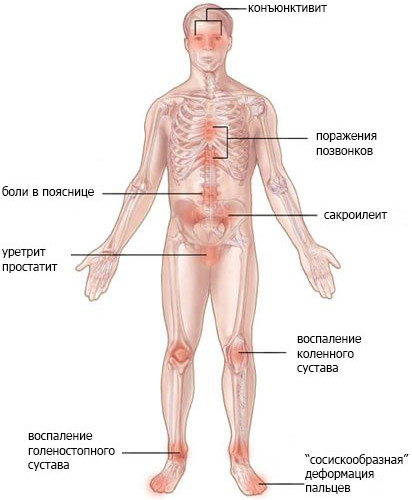 Синдром Рейтера. Симптомы, что это за болезнь, лечение