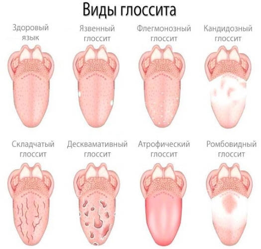 Синдром Рейтера. Симптомы, что это за болезнь, лечение