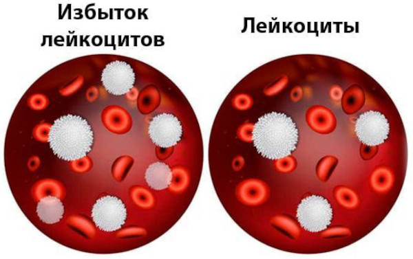 Синдром Рейтера. Симптомы, что это за болезнь, лечение