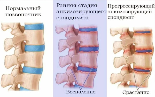 Синдром Рейтера. Симптомы, что это за болезнь, лечение