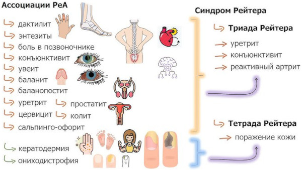 Синдром Рейтера. Симптомы, что это за болезнь, лечение