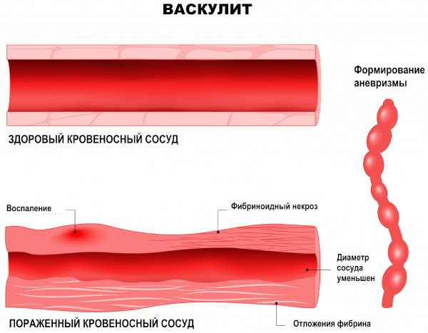 Системные васкулиты. Классификация, клинические рекомендации