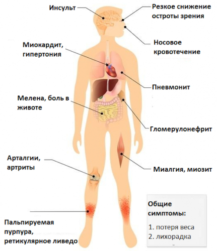 Системные васкулиты. Классификация, клинические рекомендации