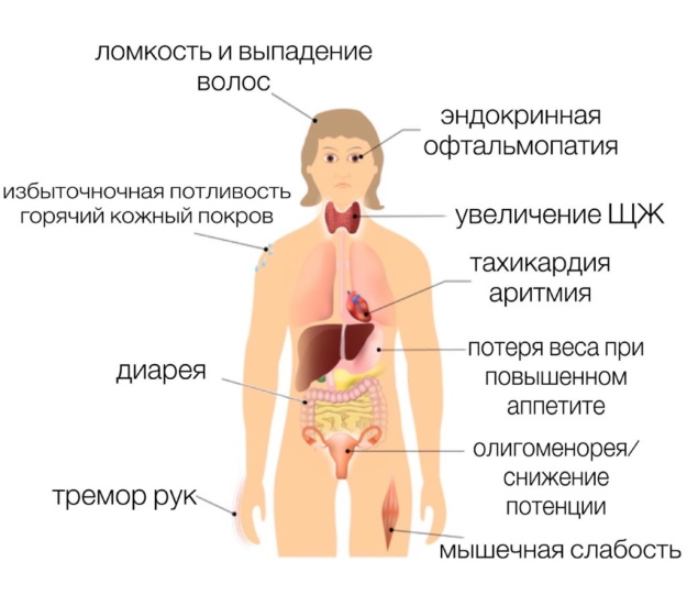 Болезнь Грейвса. Что это, симптомы, лечение