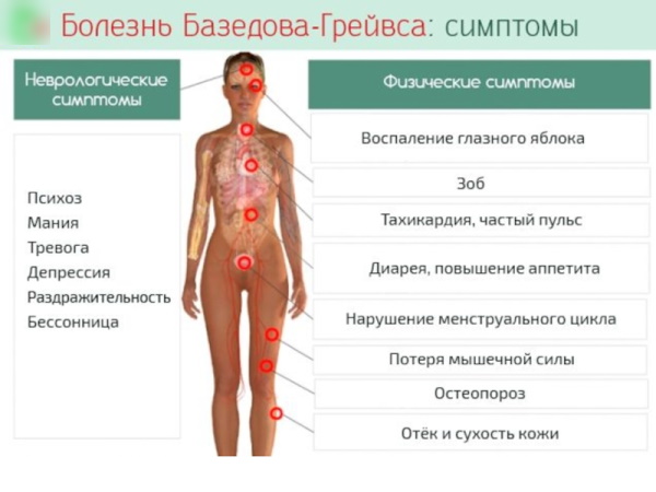 Болезнь Грейвса. Что это, симптомы, лечение