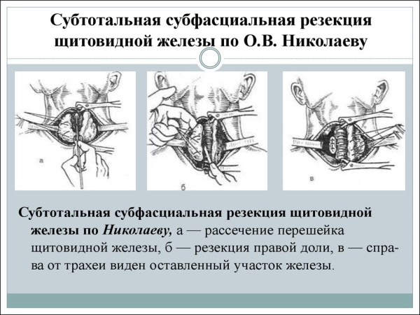 Болезнь Грейвса. Что это, симптомы, лечение