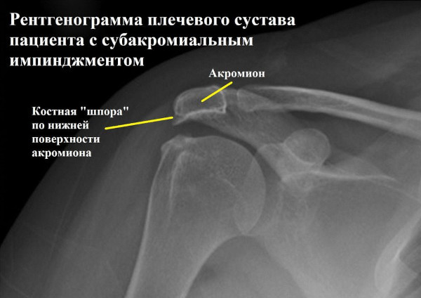 Импиджмент-синдром плечевого сустава. Лечение, рентген