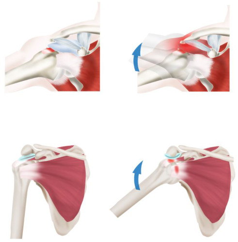Импиджмент-синдром плечевого сустава. Лечение, рентген