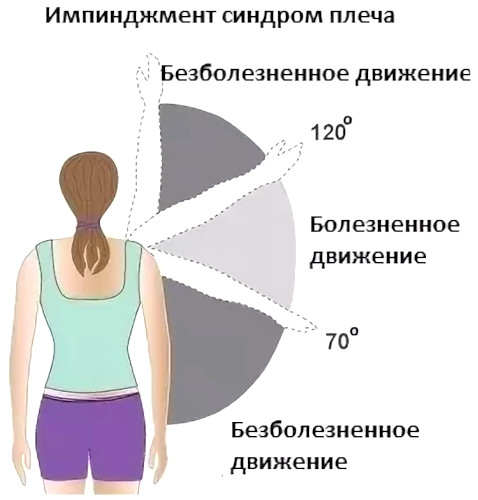 Импиджмент-синдром плечевого сустава. Лечение, рентген