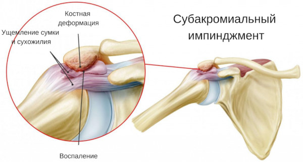 Импиджмент-синдром плечевого сустава. Лечение, рентген