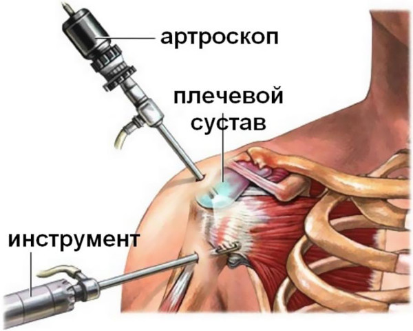 Импиджмент-синдром плечевого сустава. Лечение, рентген