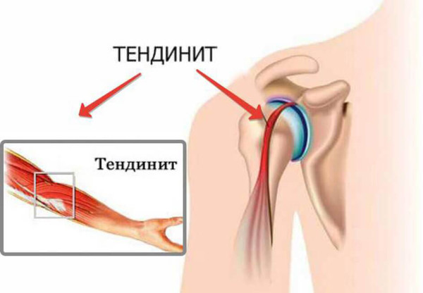 Импиджмент-синдром плечевого сустава. Лечение, рентген