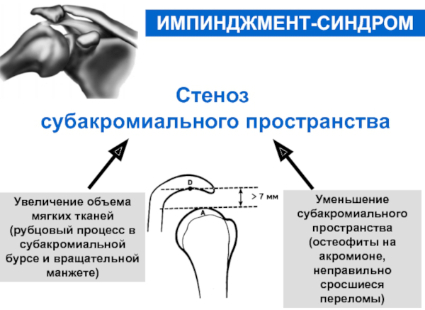 Импиджмент-синдром плечевого сустава. Лечение, рентген