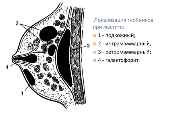 Лактационная аменорея. Что это такое, лечение