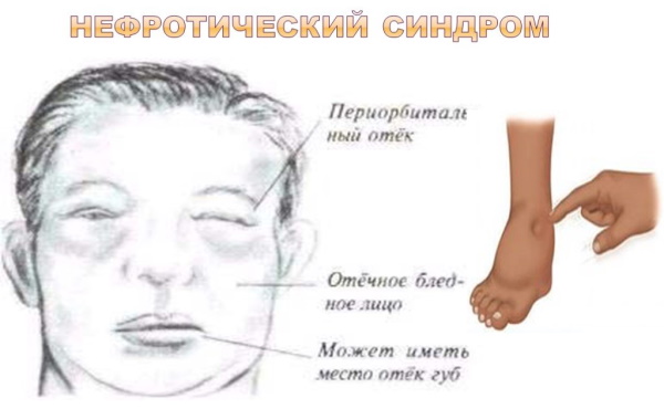 Леспенефрил и аналоги без спирта в таблетках. Цены