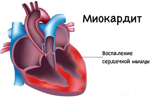 Миокардит у детей. Симптомы, лечение, диагностика