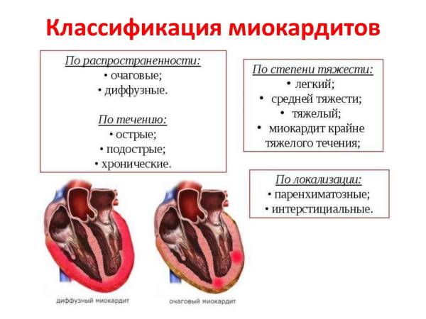 Миокардит у детей. Симптомы, лечение, диагностика