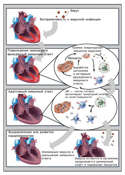 Миокардит у детей. Симптомы, лечение, диагностика