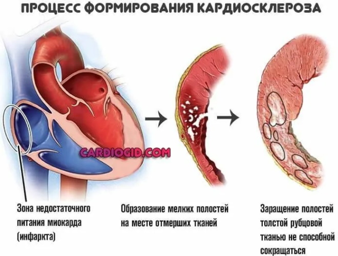 Миокардит у детей. Симптомы, лечение, диагностика