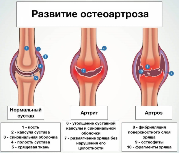 Остеоартроз локтевого сустава у женщин. Что это, лечение