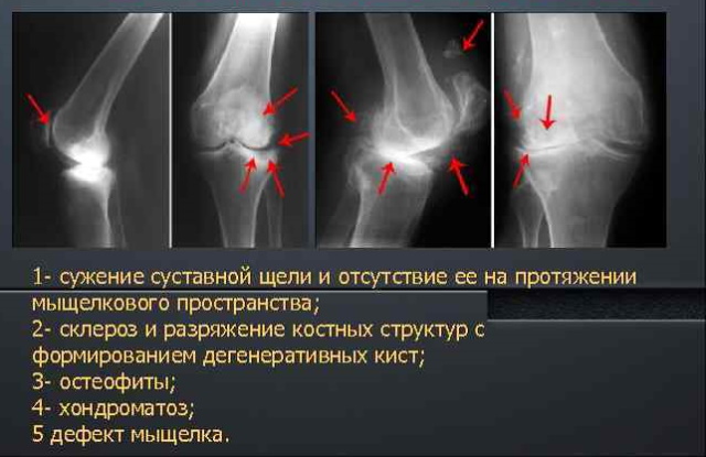 Остеоартроз локтевого сустава у женщин. Что это, лечение