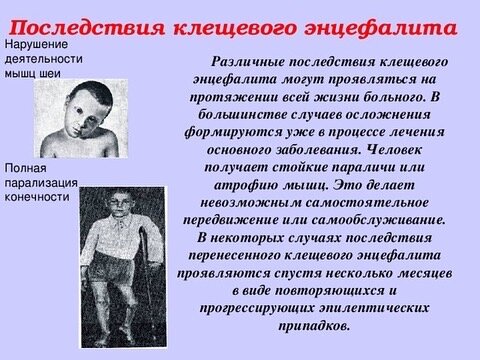 Последствия клещевого энцефалита головного мозга