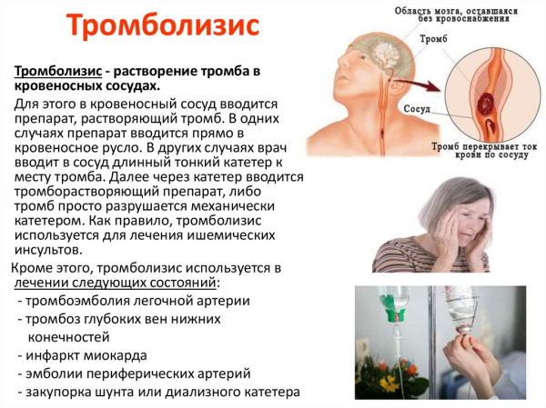 Синдром Дресслера при инфаркте миокарда. Лечение