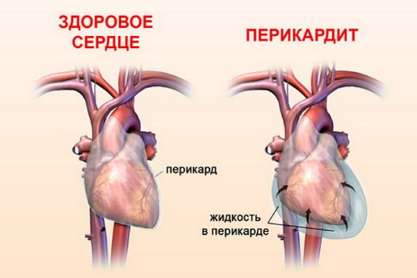 Синдром Дресслера при инфаркте миокарда. Лечение