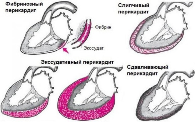 Синдром Дресслера при инфаркте миокарда. Лечение