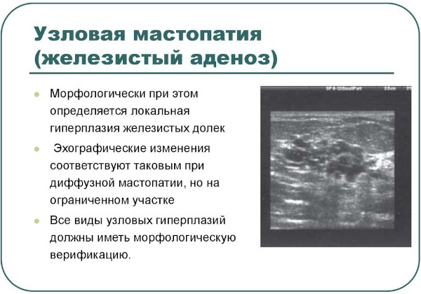 Аденоз молочной железы. Что это, УЗИ, лечение