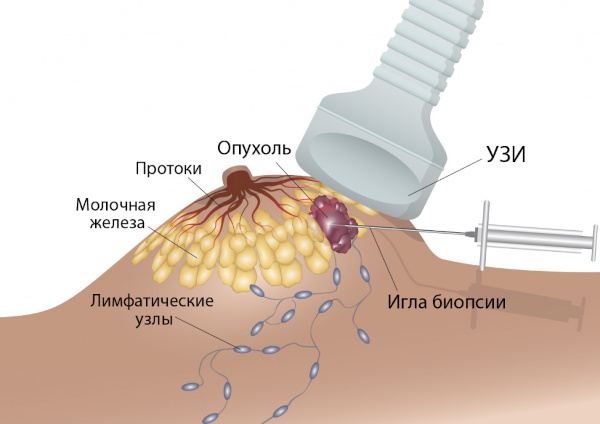 Аденоз молочной железы. Что это, УЗИ, лечение