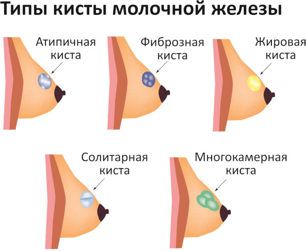 Аденоз молочной железы. Что это, УЗИ, лечение