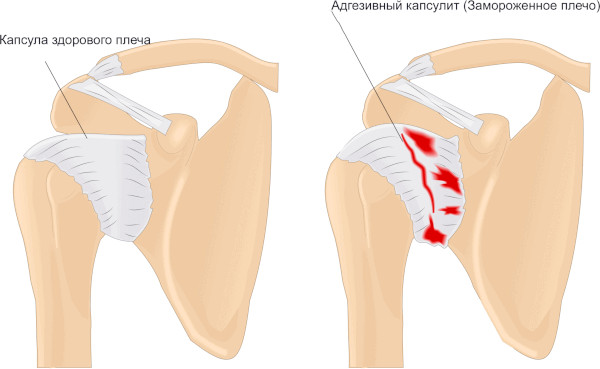 Адгезивный капсулит плечевого сустава. Что это, лечение