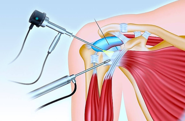 Адгезивный капсулит плечевого сустава. Что это, лечение