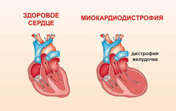 Дифиллоботриоз. Лечение человека: препараты