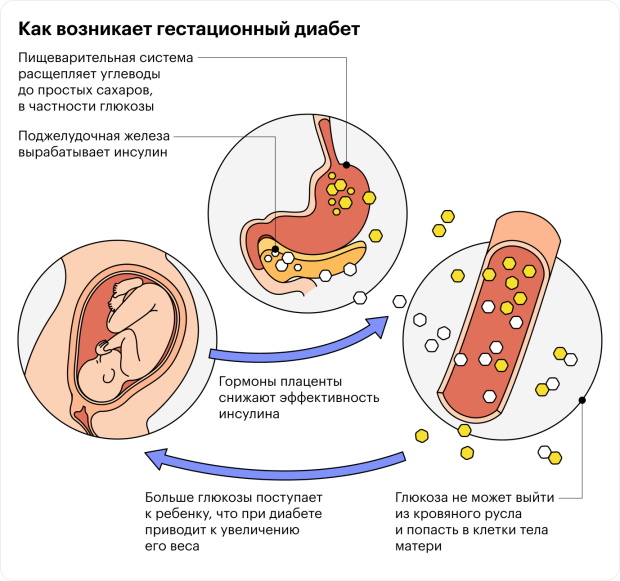 Гестационный сахарный диабет при беременности. Клинические рекомендации