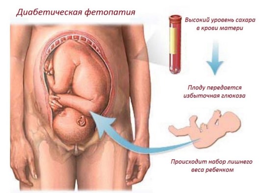 Гестационный сахарный диабет при беременности. Клинические рекомендации