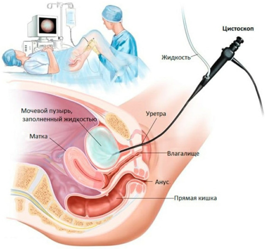 Инстилляции мочевого пузыря при цистите у женщин