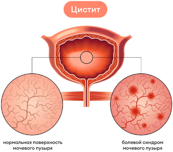 Инстилляции мочевого пузыря при цистите у женщин