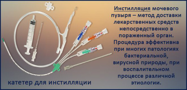 Инстилляции мочевого пузыря при цистите у женщин