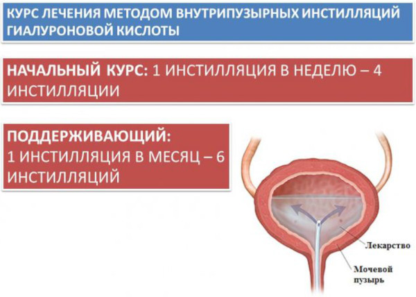 Инстилляции мочевого пузыря при цистите у женщин