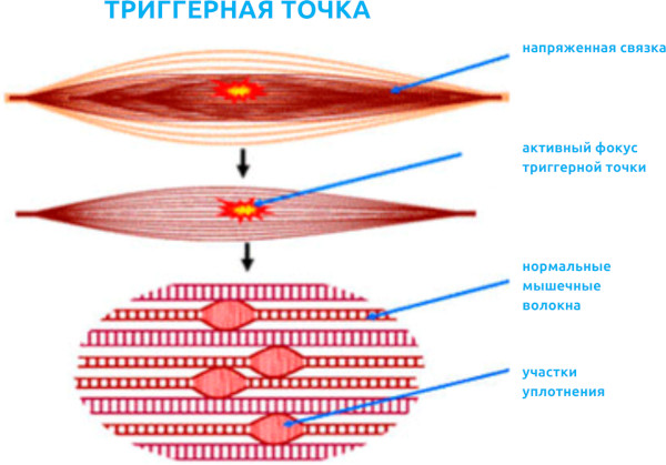 Миофасциальный массаж. Что это такое, для чего нужен