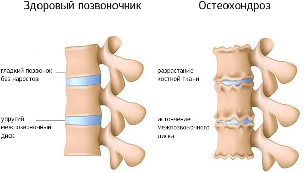 Миофасциальный массаж. Что это такое, для чего нужен